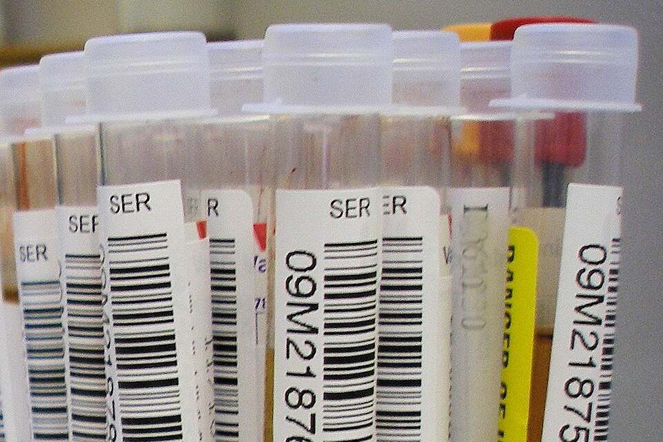 HIV Children Monthly Aid — laboratory blood test tubes during HIV testing